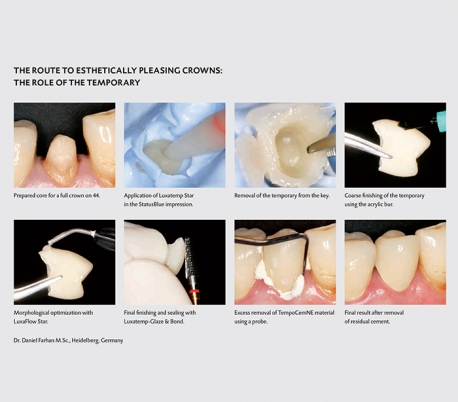 DMG Luxatemp Fluorescence Temporary Crowns Bridges Material Dandal