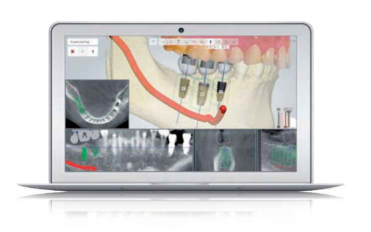 digital implantology