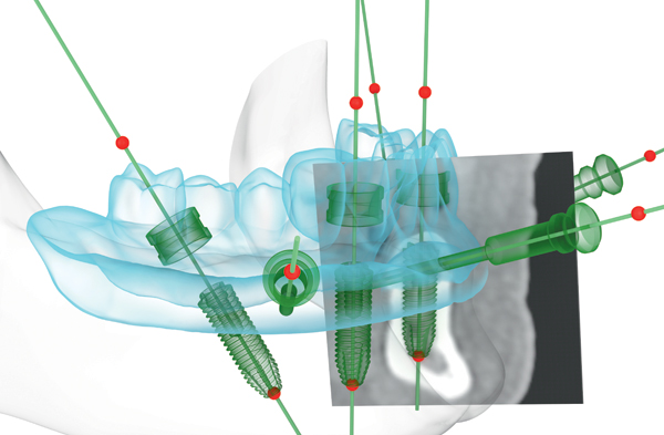 digital implantology