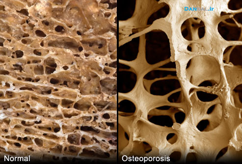 osteoporotic-dandal