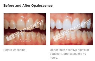 ultradent teeth whitening gel