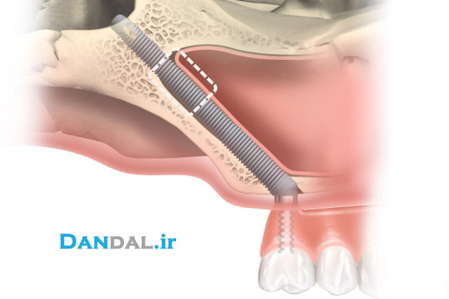 dandal - zygomatic