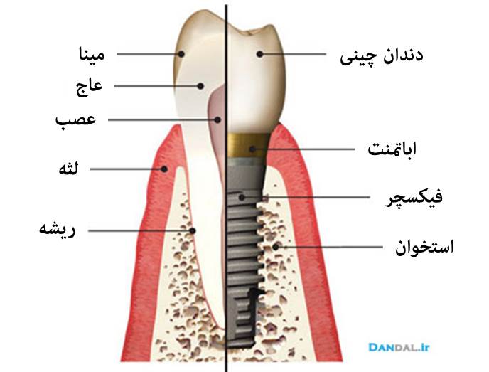 implant-dandal