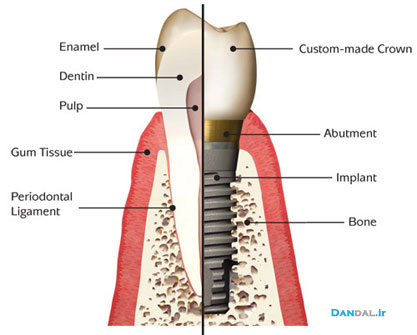 implant - dandal