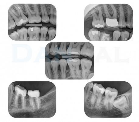 3Disc - FireCR Dental Reader