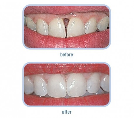 Cosmedent - Renamel Gingafill Composite