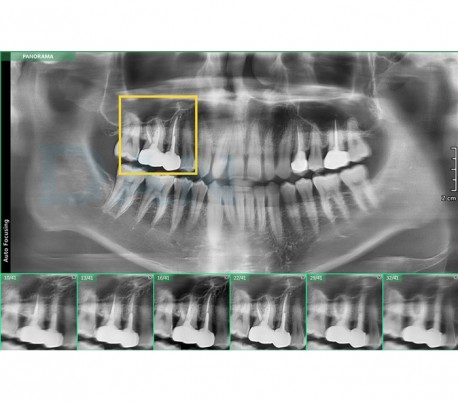 Vatech - PaX-i Insight 2D Imaging