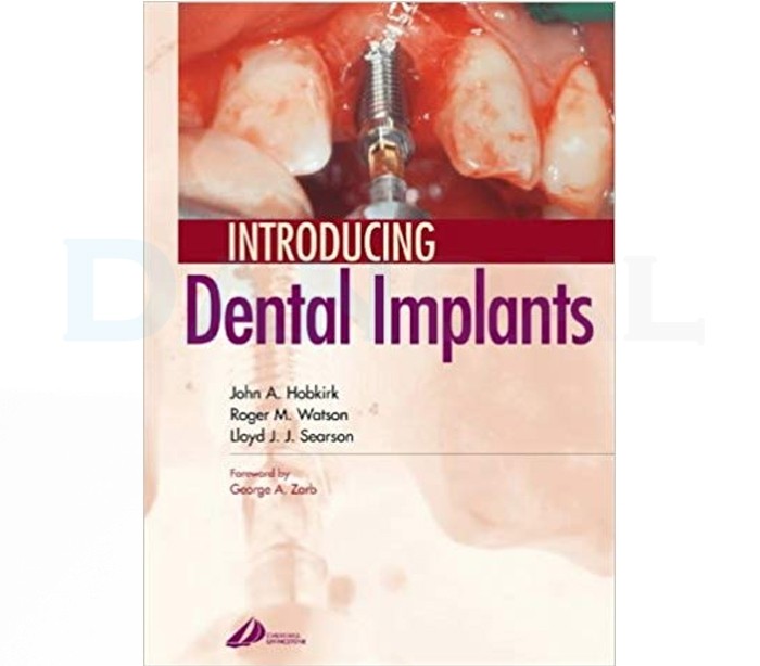 Introducing Dental Implants