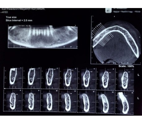 Advanced Consultation Package for Implantation