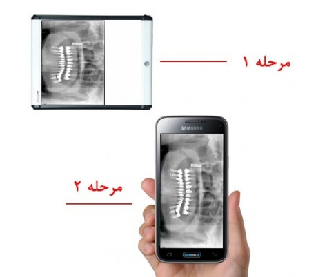 مشاوره رفع مشکلات ایمپلنت