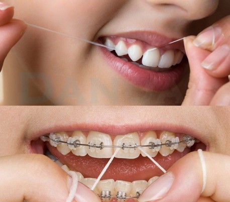 HealTech - Clear Aligners