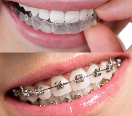 HealTech - Clear Aligners