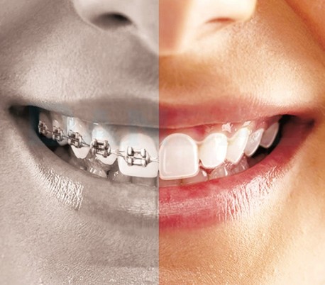 HealTech - Clear Aligners