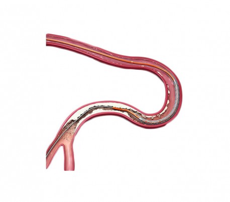 Xience Xpedition Everolimus Eluting Stent - Abbott Vascular