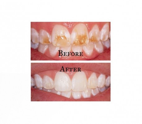 UltraDent - Opalustre Enamel Microabrasion