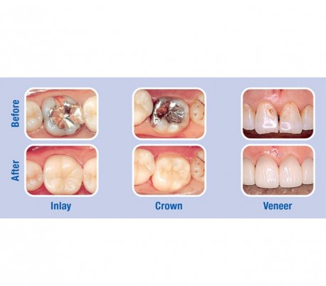 Kuraray - Panavia F2.0 Dual-Cure Adhesive System