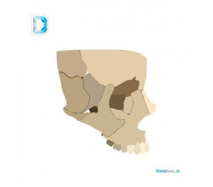 Maxillary modeling by 3D printer