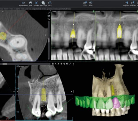 Planmeca - Emerald S Colored Intraoral Scanner