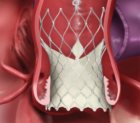 Medtronic - Evolut R System Transcatheter Aortic Valve