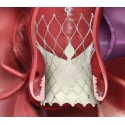 Medtronic - Evolut R System Transcatheter Aortic Valve