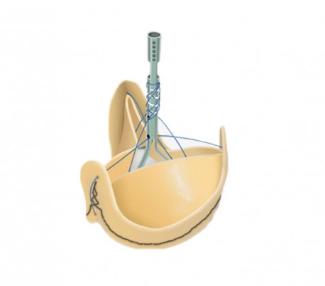 Sorin - Solo Smart Aortic Heart Valve