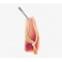 Sorin - Solo Smart Aortic Heart Valve