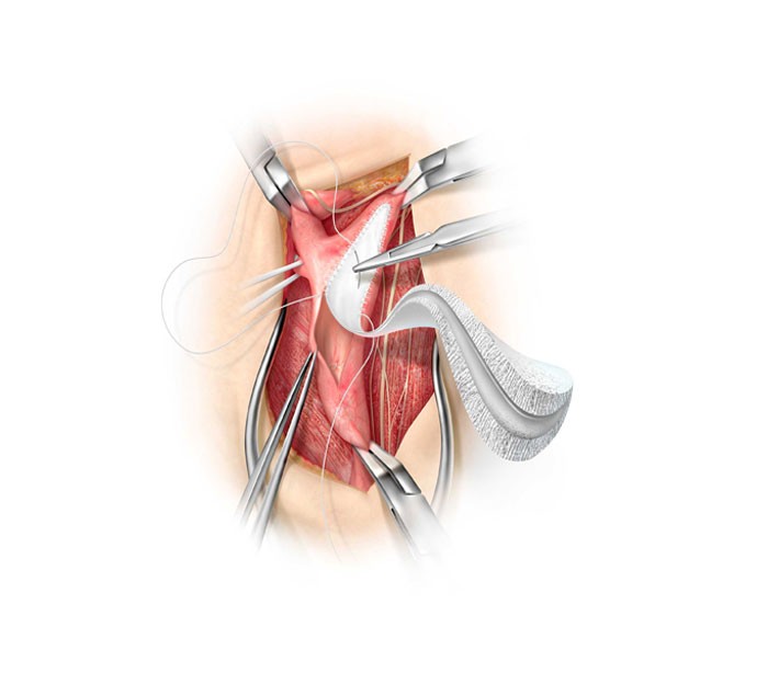 Gore Medical - Gore Acuseal Cardiovascular Patch