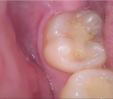 دوربین داخل دهانی بی سیم GoodDrs - Dr's Cam