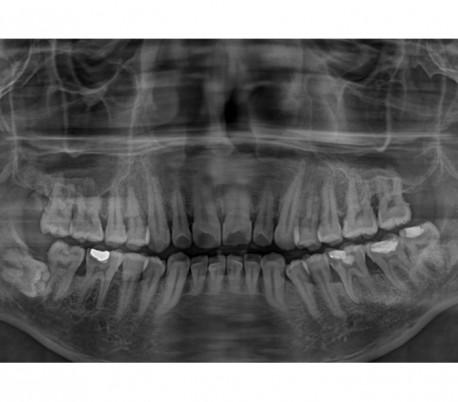 Trident - X-VIEW 2D PAN Panoramic X-ray System