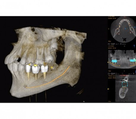 سی تی اسکن دندان (CBCT) مدل Carestream - CS9600