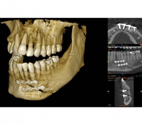 سی تی اسکن دندان (CBCT) مدل Carestream - CS9600