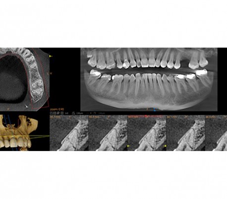 سی تی اسکن دندان (CBCT) مدل Carestream - CS8100 EVO 3D