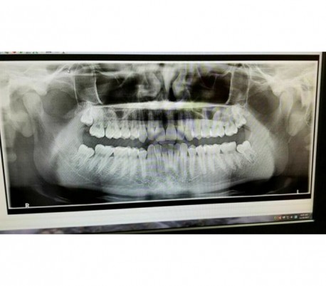 Carestream - CS8100 (OPG) Panoramic X-ray system