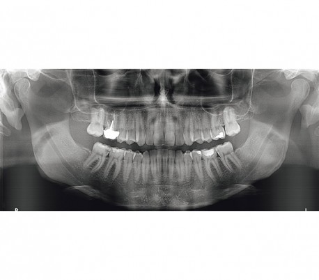 Carestream - CS8100 (OPG) Panoramic X-ray system