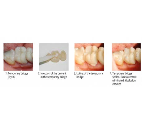 Elsodent - Seal Temp Temporary Cement