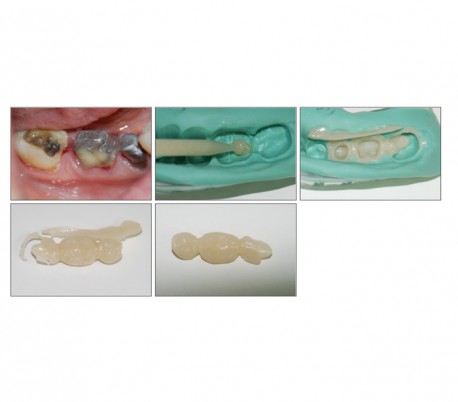 Elsodent - Phoenix MD Composite