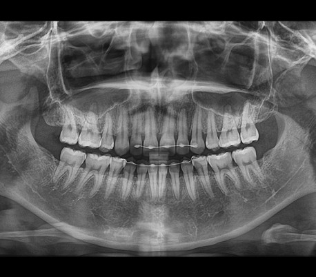 Genoray - Papaya 3D Plus (OPG) X-Ray Imaging System