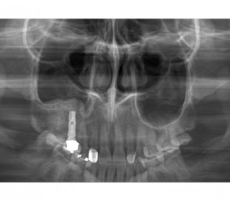 Genoray - Papaya 3D Plus (OPG) X-Ray Imaging System