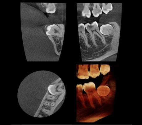 Genoray - Papaya 3D Plus (OPG) X-Ray Imaging System