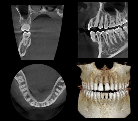 Genoray - Papaya 3D Plus (OPG) X-Ray Imaging System