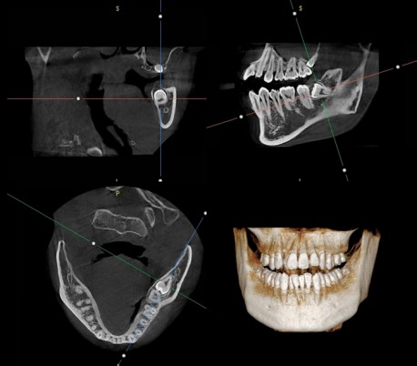 Genoray - Papaya 3D Plus (OPG) X-Ray Imaging System