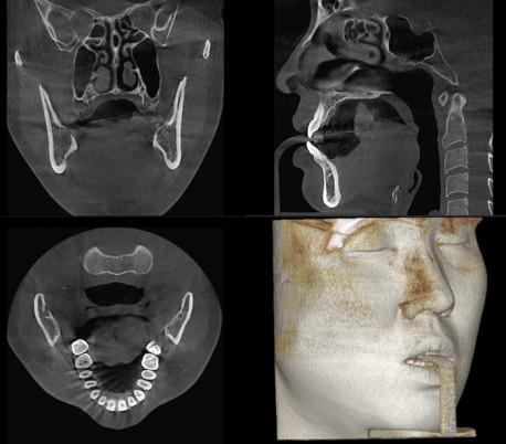 Genoray - Papaya 3D Plus (OPG) X-Ray Imaging System