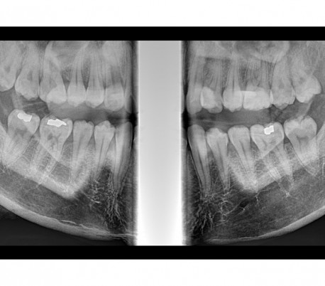 Genoray - Papaya Plus (OPG) X-Ray Imaging System