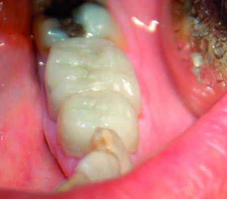 Elsodent - Phoenix MD Composite