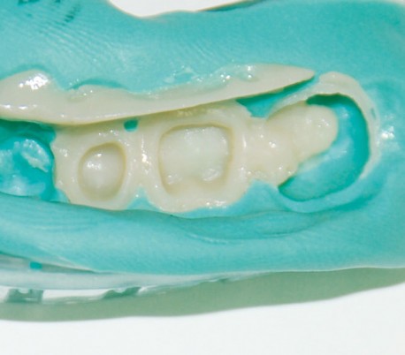 Elsodent - Phoenix MD Composite