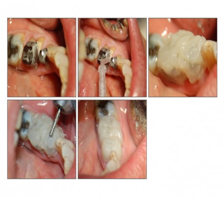 Elsodent - Phoenix MD Composite