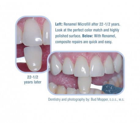 کامپوزیت انامل Renamel Microfill سوپربرایت - Cosmedent