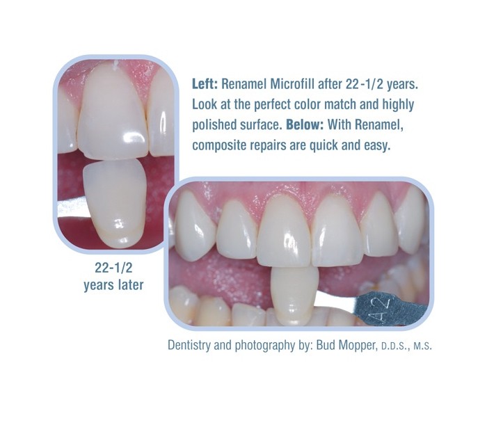 Cosmedent - Renamel Microfill Composite as Enamel shade - Dandal ...