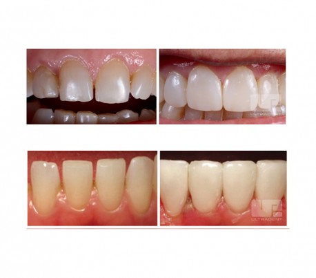 UltraDent - Uveneer Kit