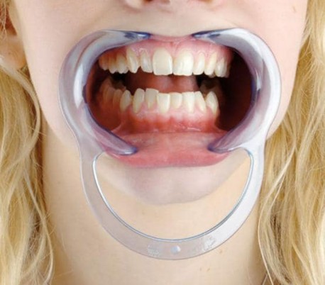 Transparent Blue Cheek Retractor Double Sided